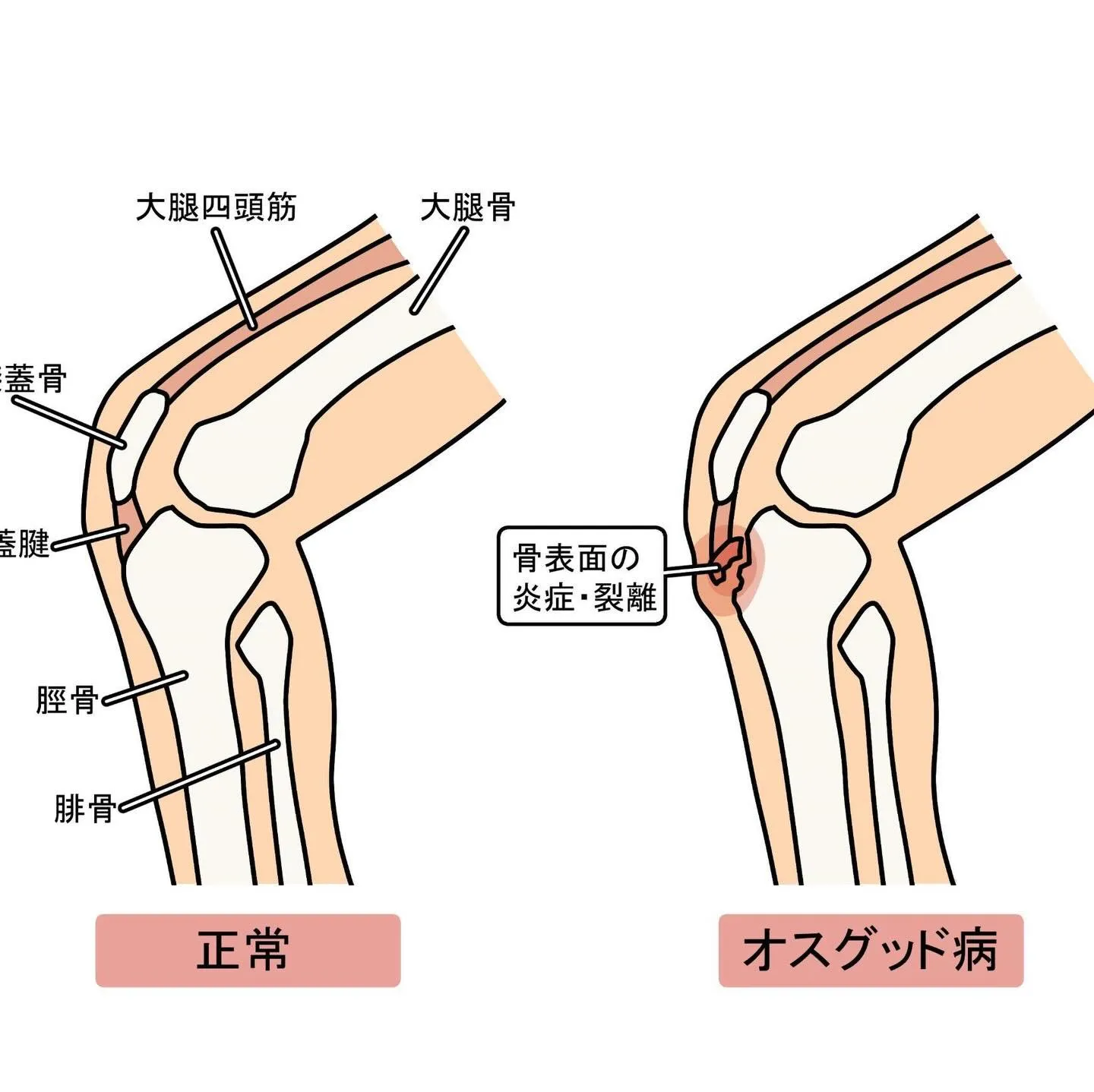 ☀️オスグット病について☀️