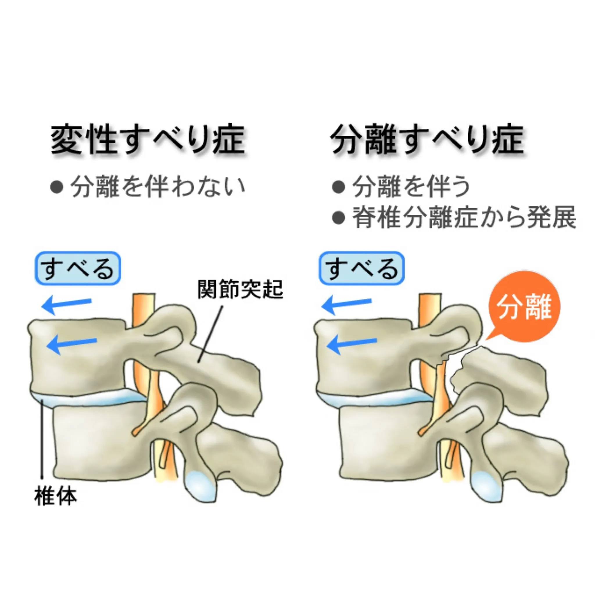☀️腰椎すべり症について☀️